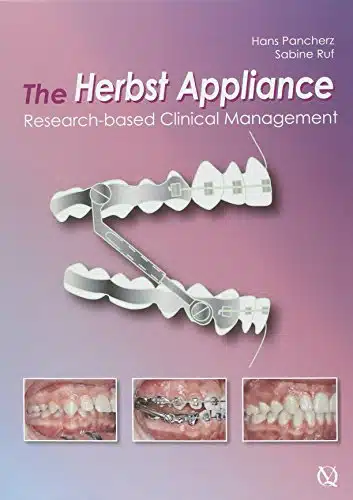 The Herbst Appliance Research Based Clinical Management